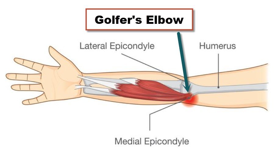 Golfer's Elbow Rehab & Force Board Training